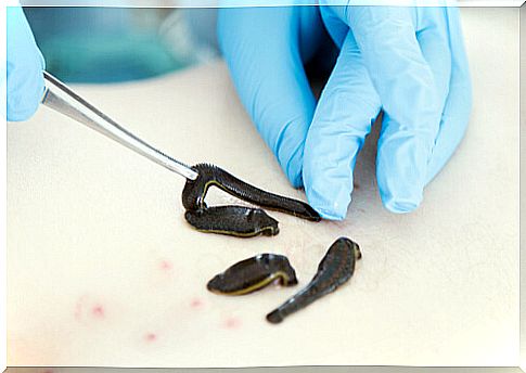 Leech therapy